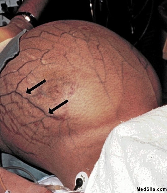 выраженный асцит с венозной сетью